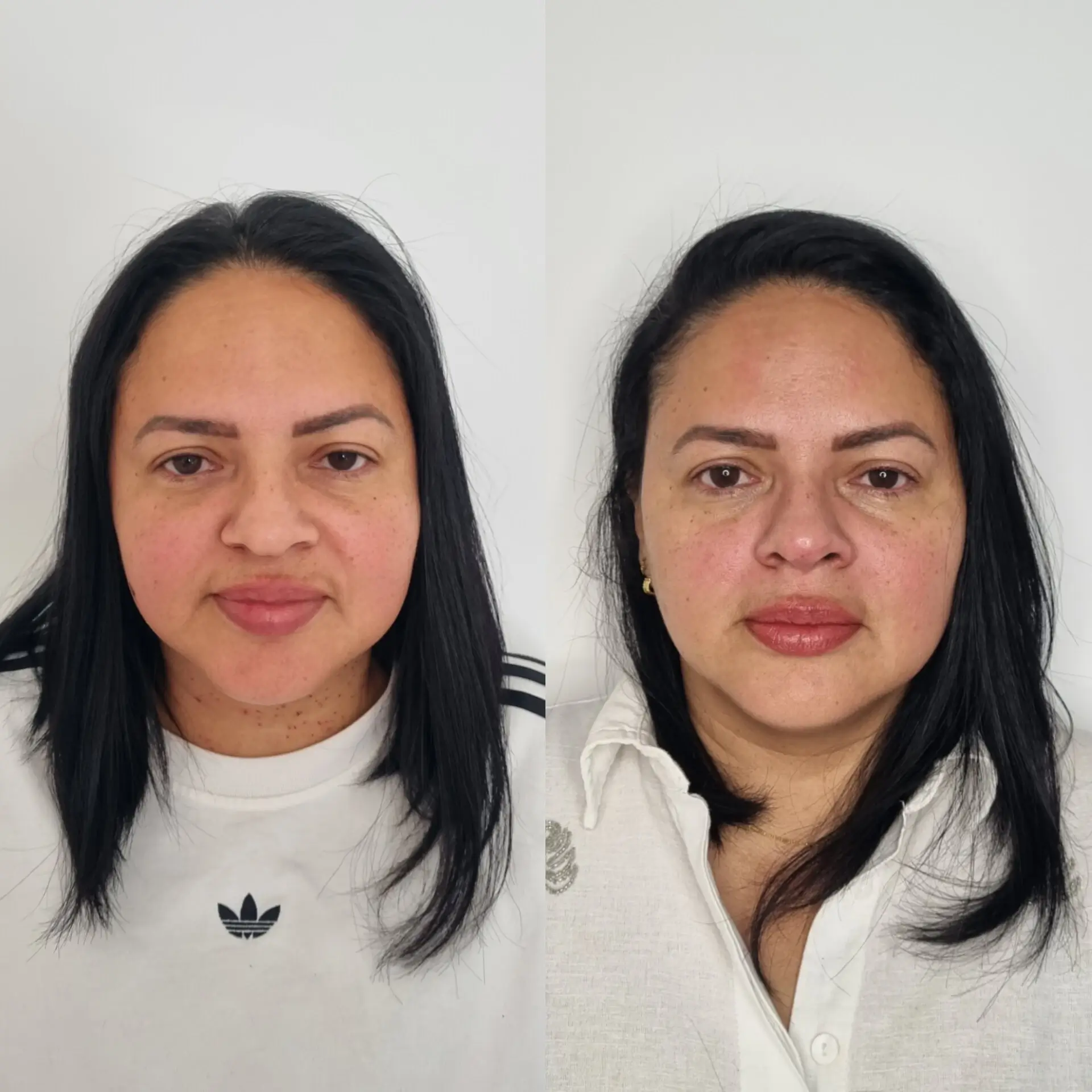 Antes e Depois - Harmonização Facial 1