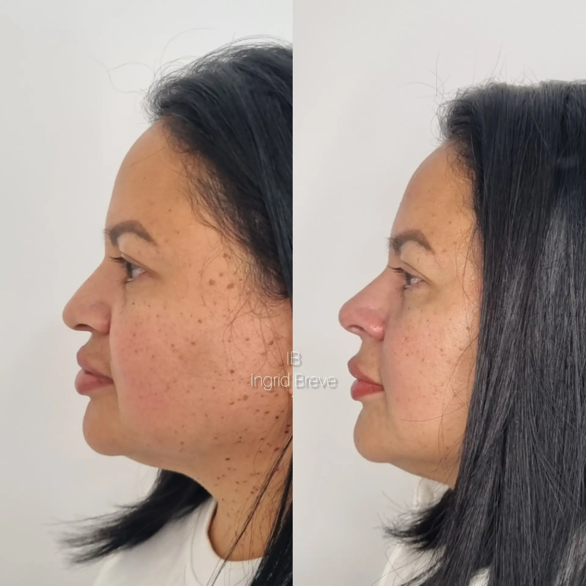 Antes e Depois - Harmonização Facial 2