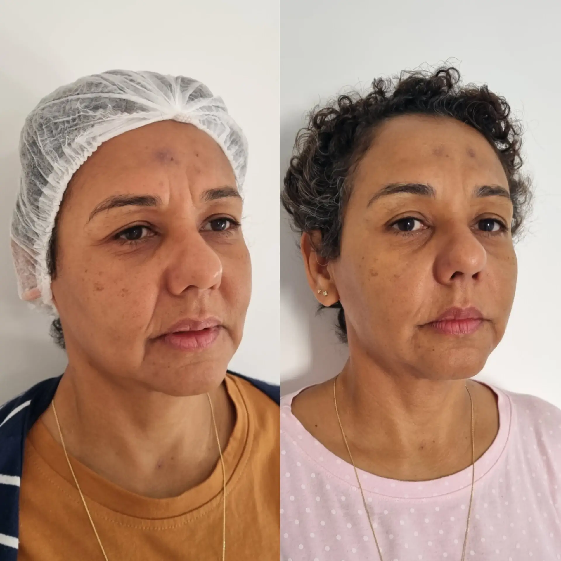 Antes e Depois - Harmonização Facial 3