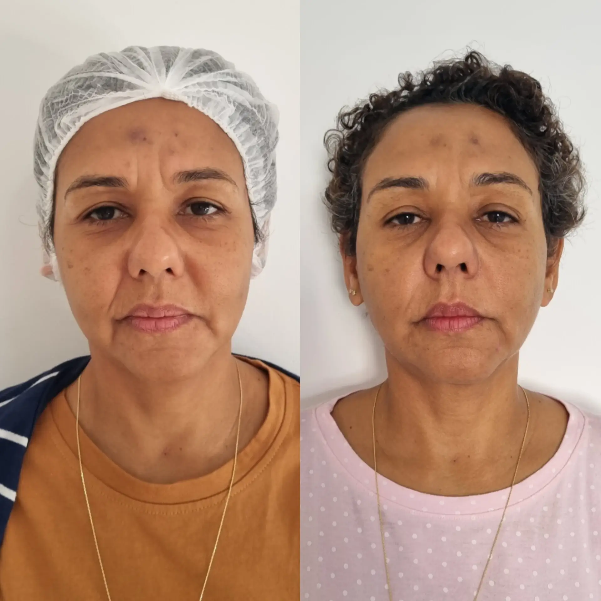 Antes e Depois - Harmonização Facial 4