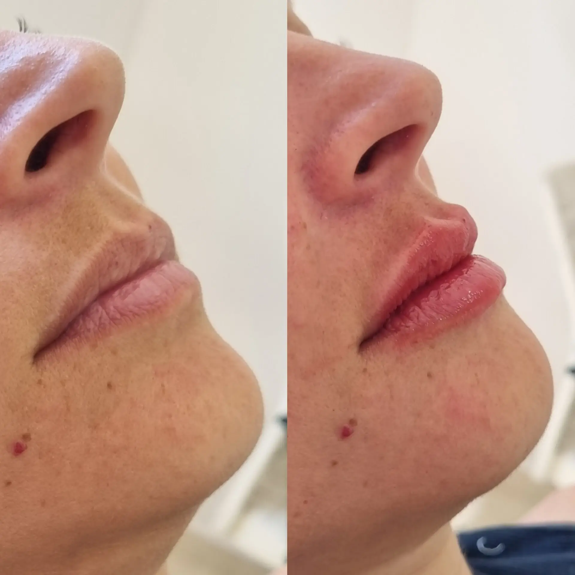 Antes e Depois - Harmonização Facial 5
