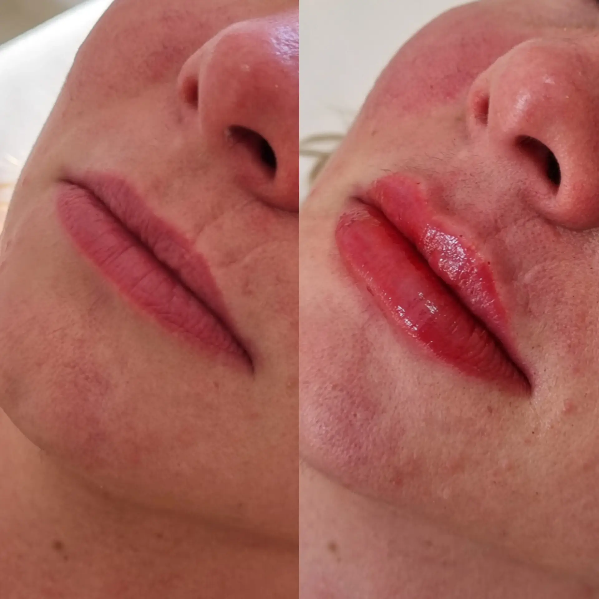 Antes e Depois - Harmonização Facial 6